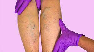 varicose veins varicose veins